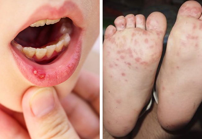 ¿Qué es esta nueva enfermedad llamada ‘síndrome mano-boca-pies’?